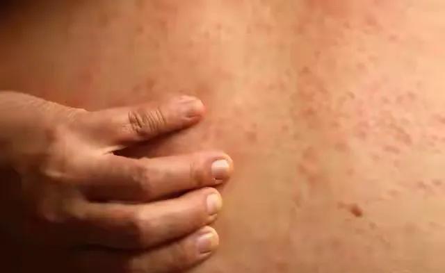 全球疫情反弹!麻疹输入风险增高,出行警惕